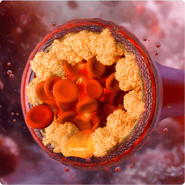 Trapped Cholesterol Gets Released.